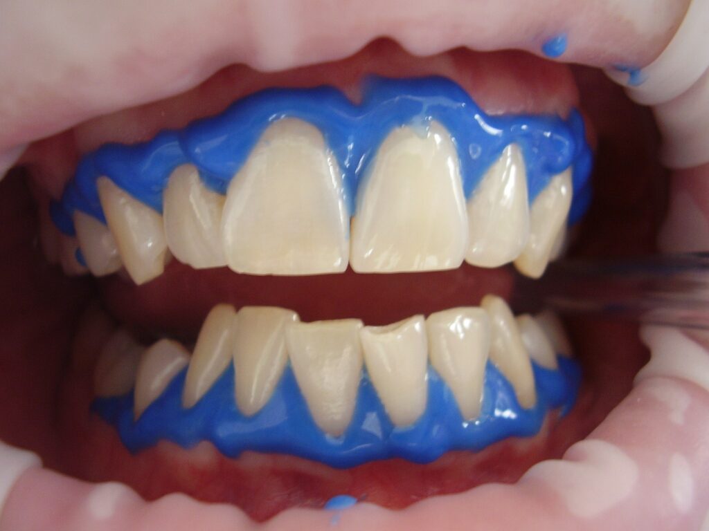 tänder som bleks med laserblekning