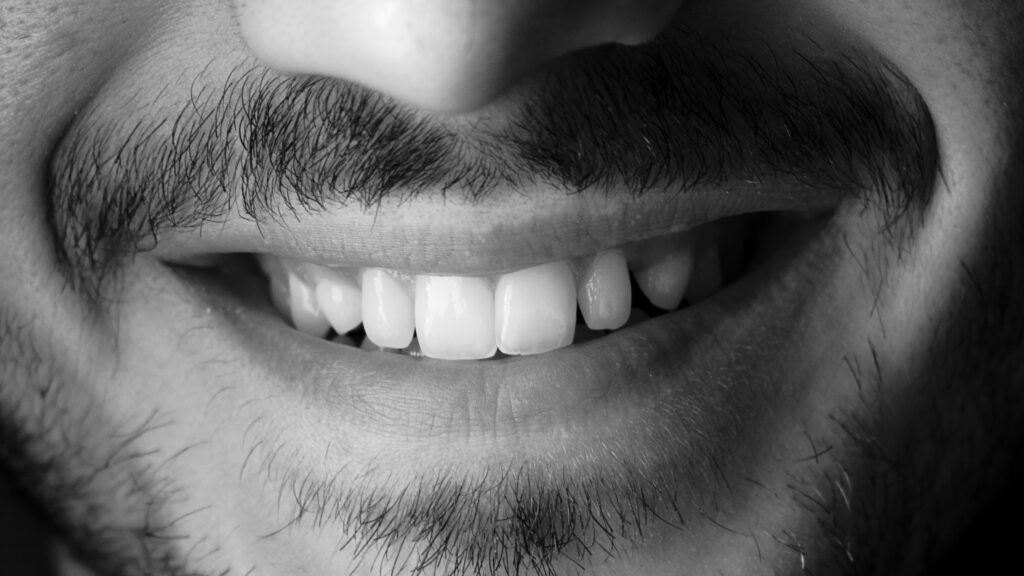 kritvita tänder som blekts med tandblekningsremsor